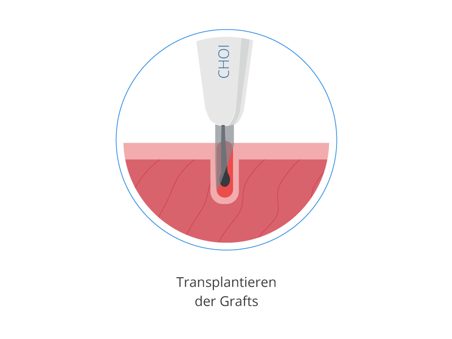 Grafik zum Verpflanzen der Grafts mit der DHI Haartransplantation