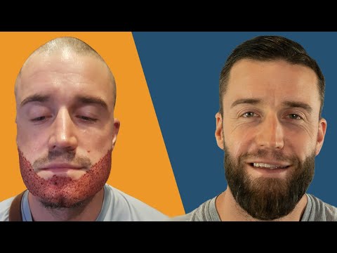 Thumbnail Barttransplantation Vergleich Vorher Nachher Patienten