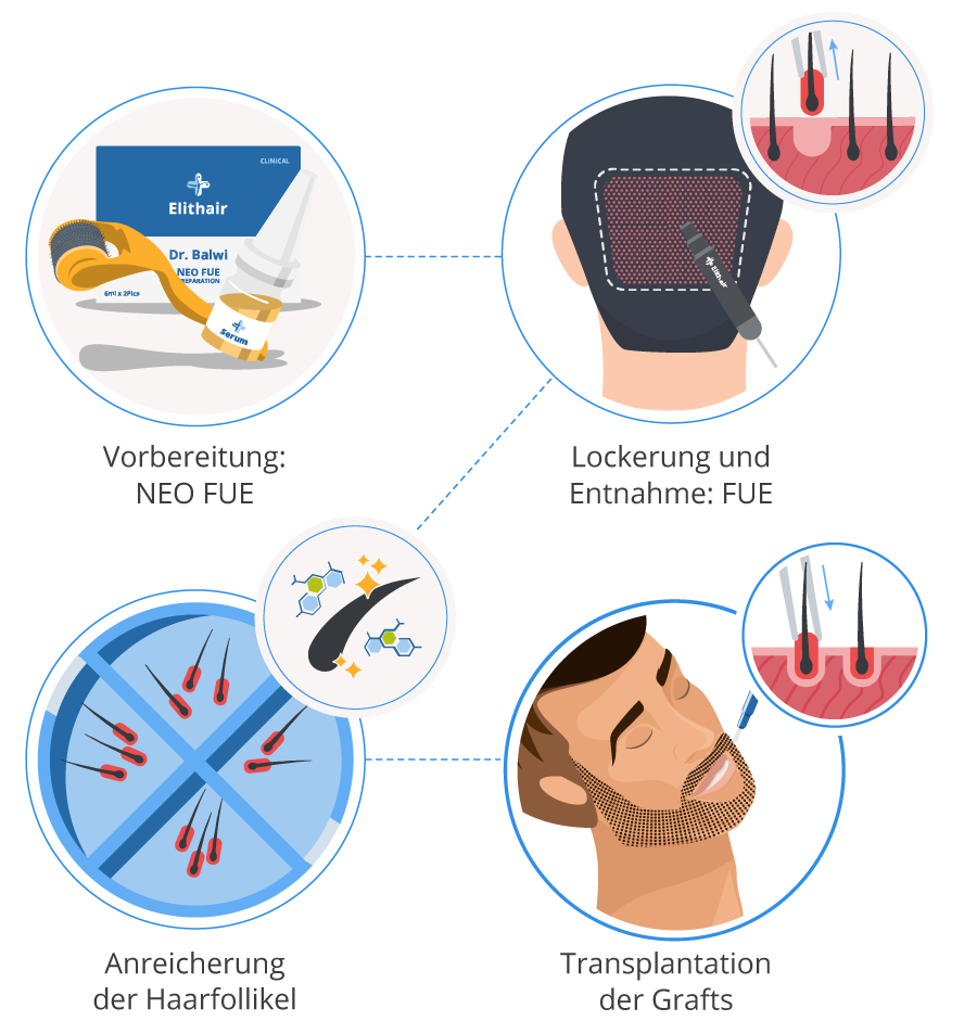 Infografik der 4 Schritte für die Barttransplantation