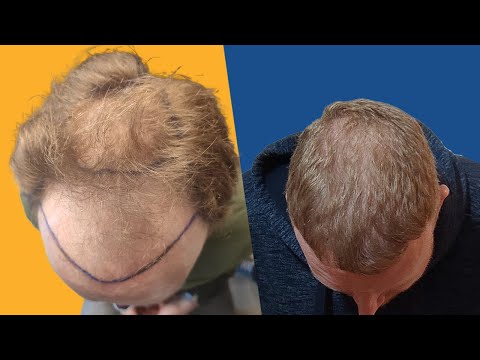 Thumbnail Haartransplantation Vergleich Vorher Nachher Patienten