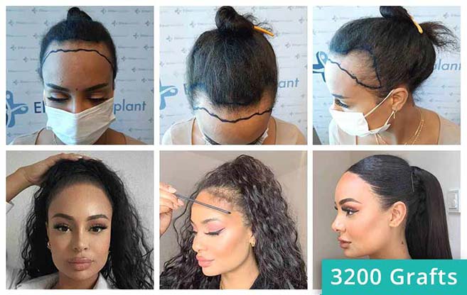 Haartransplantation Vorher Nachher Vergleich der Patientin Jahy C