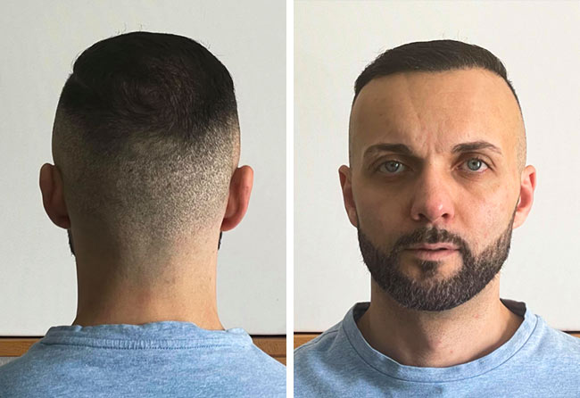 Salvatore B.: Vorher Nachher Bilder - 4000 Grafts | Elithair