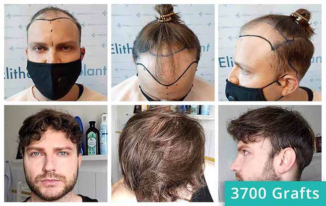 Patient im Vorher Nachher Vergleich bei der Haartransplantation in der Türkei von Edgar Noskovs