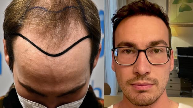 Thumbnail Vorher Nachher Vergleich Patienten Haartransplantation Türkei