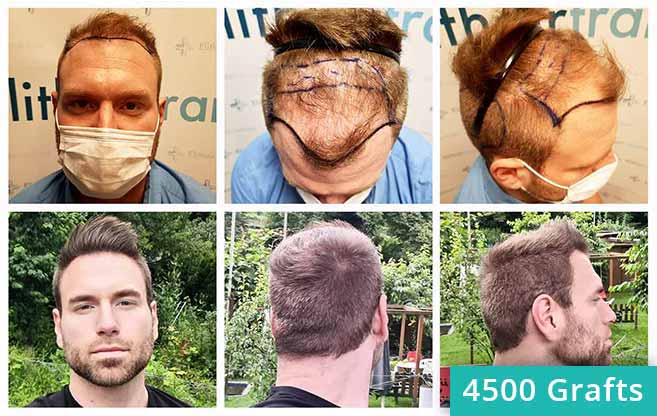 Vorher Nachher FUE Haartransplantation Bilder von Kewin Lenzing
