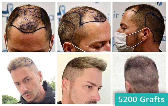 Vorher Nachher FUE Haartransplantation Bilder von Patient Andre O
