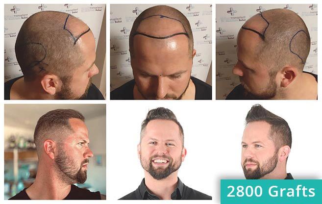 Vorher Nachher Haartransplantation Bilder von Patient Nico Gumlich