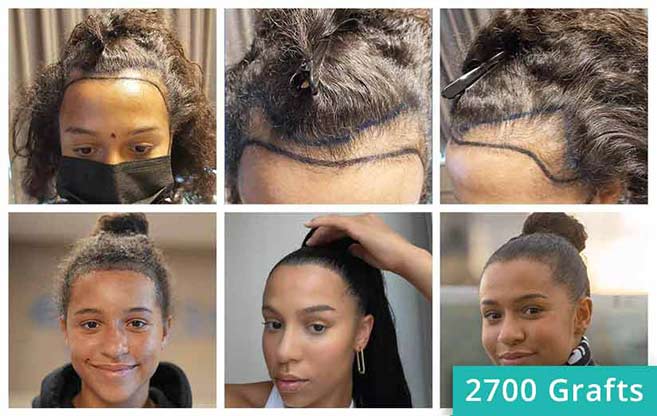 Vorher Nachher Haartransplantation Bilder der Patientin Melissa Zerhau