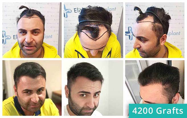 Vorher Nachher Saphir Haartransplantation Bilder von Patient Murat Kizilkaya