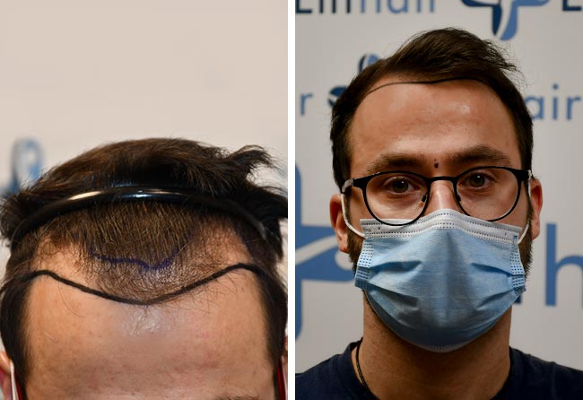 Vorher DHI Haartransplantation mit 3100 Grafts von Patient Ricardo Beier