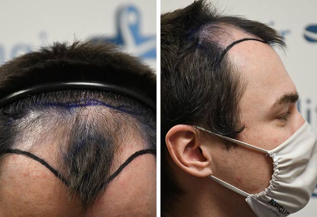 Vorher DHI Haartransplantation mit 3500 Grafts bei Patient Chris Scholz