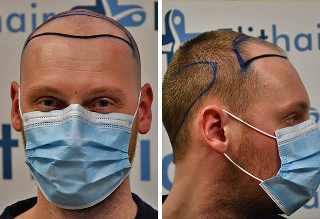 Vorher DHI Haartransplantation mit 3950 Grafts von Patient Oliver Dietrich