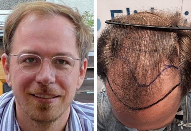 Vorher DHI Haartransplantation mit 4500 Grafts von Patient Tobias Plümacher