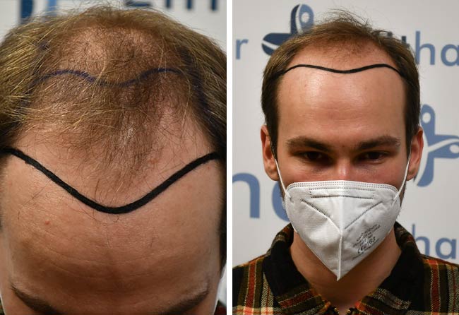 Vorher DHI Haartransplantation mit 4700 Grafts von Patient Marcel Ploch