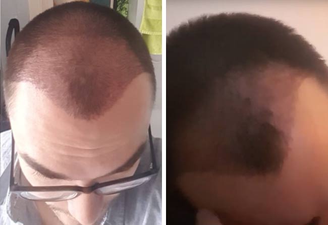 Vorher nachher DHI Haartransplantation mit 3500 Grafts bei Patient Chris Scholz nach 1 Monat