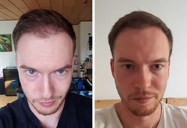 Vorher nachher DHI Haartransplantation mit 3500 Grafts bei Patient Lukas Jäger nach 4 Monaten