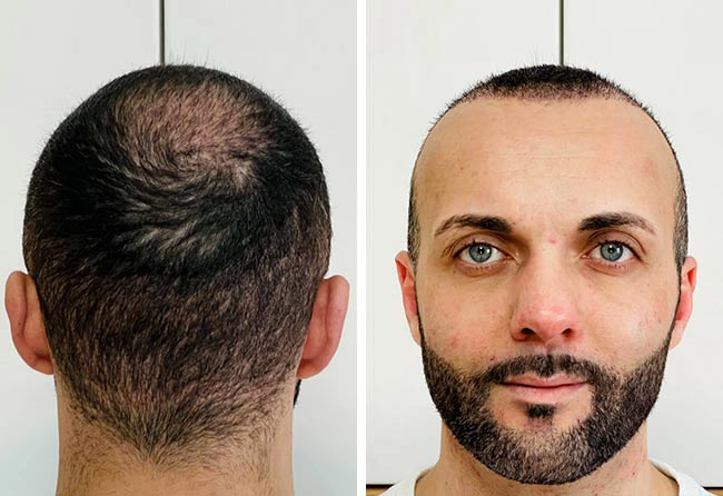 Salvatore B.: Vorher Nachher Bilder - 4000 Grafts | Elithair