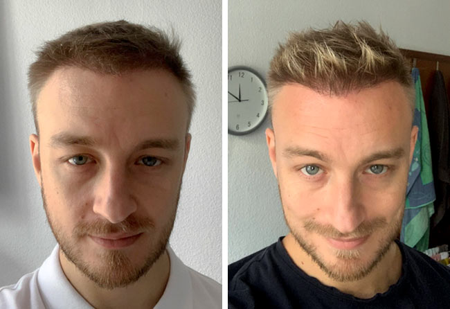 Vorher Nachher DHI Haartransplantation mit 4200 Grafts von Patient Marius Schmiddi nach 6 Monaten