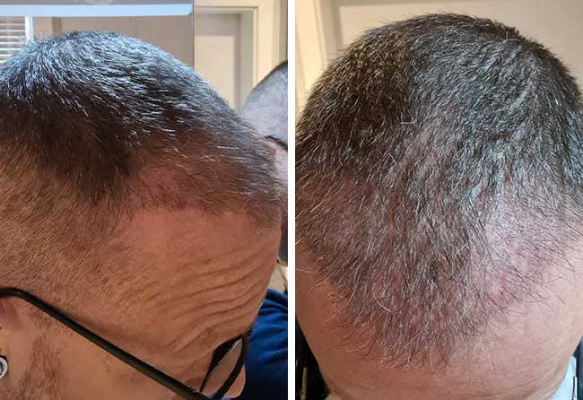 Vorher Nachher DHI Haartransplantation mit 4500 Grafts von Patient Steffen Kräuter nach 5 Monaten