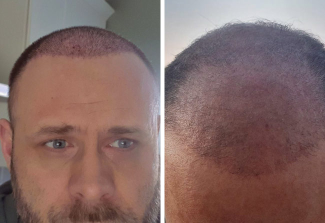 Vorher Nachher Perkutan Haartransplantation mit 3700 Grafts von Patient Michael Woulfe nach 2 Monaten