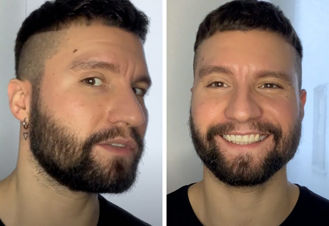 Vorher nachher Saphir Barttransplantation mit 3500 Grafts bei Patient Dominik Schmitz nach 4 Monaten