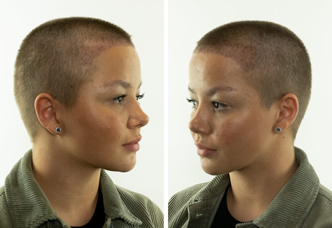 Vorher Nachher Saphir Haartransplantation mit 2600 Grafts von Patientin Lilianna Steinhöffel nach 2 Monaten