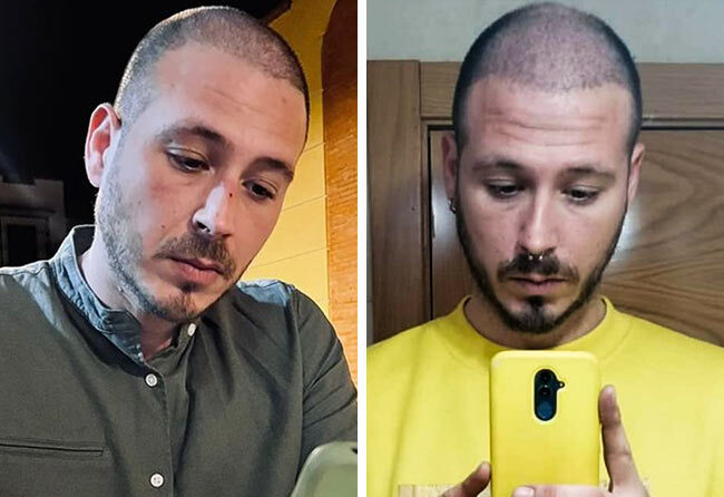 Vorher Nachher Saphir Haartransplantation mit 4200 Grafts von Patient Jorge Díaz nach 3 Monaten