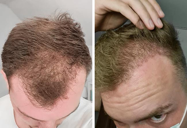 Vorher nachher Saphir Haartransplantation mit 4200 Grafts bei Patient Marc Stehr nach 4 Monaten