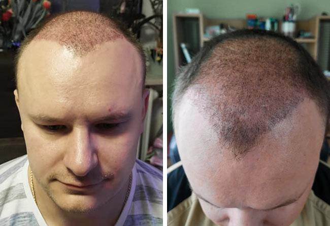Vorher Nachher Saphir Haartransplantation mit 4200 Grafts von Patient Sergej Weresomski nach 2 Monaten