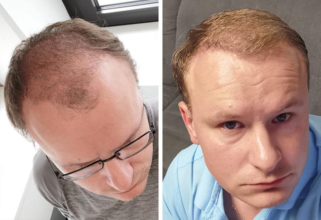 Vorher Nachher Saphir Haartransplantation mit 4200 Grafts von Patient Sergej Weresomski nach 6 Monaten