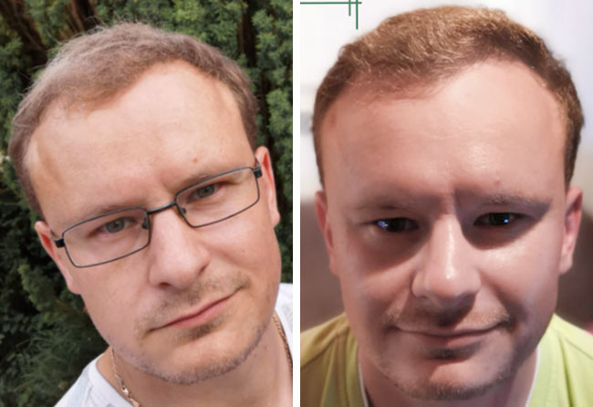 Vorher Nachher Saphir Haartransplantation mit 4200 Grafts von Patient Sergej Weresomski nach 8 Monaten
