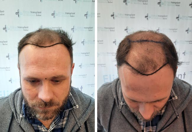 Vorher Perkutan Haartransplantation mit 3700 Grafts von Patient Michael Woulfe
