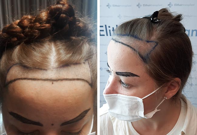 Vorher Saphir Haartransplantation mit 2600 Grafts von Patientin Lilianna Steinhöffel