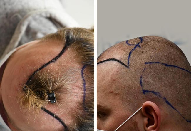 Vorher Saphir Haartransplantation mit 4200 Grafts bei Patient Marc Stehr