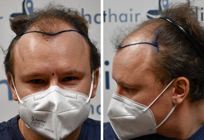 Vorher Saphir Haartransplantation mit 4200 Grafts von Patient Sergej Weresomski