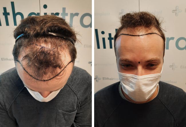 Vorher Saphir Haartransplantation mit 4500 Grafts bei Patient Didac Scheffler