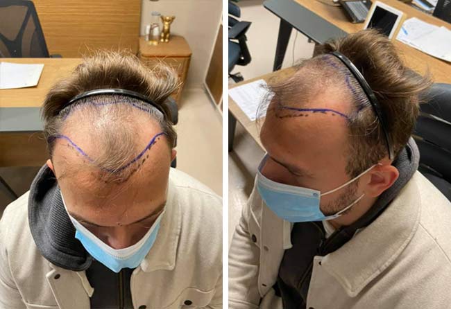 Vorher Saphir Haartransplantation mit 4500 Grafts von Patient Sefket Ahmetovic