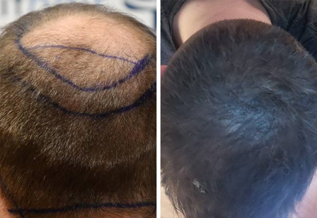 Vorher Nachher Saphir Haartransplantation mit 4700 Grafts von Patient Patrick Bertram