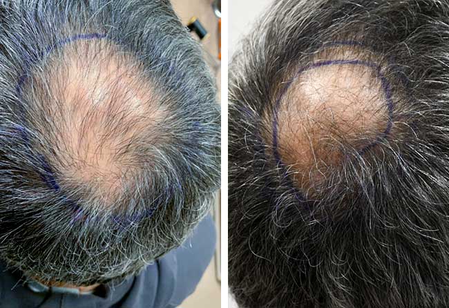 Vorher Saphir Haartransplantation mit 3000 Grafts von Patient Ziad Ma