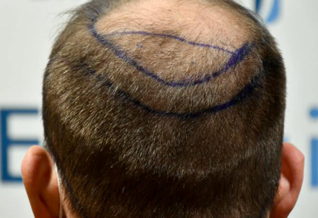 Vorher Saphir Haartransplantation mit 4700 Grafts von Patient Patrick Bertram