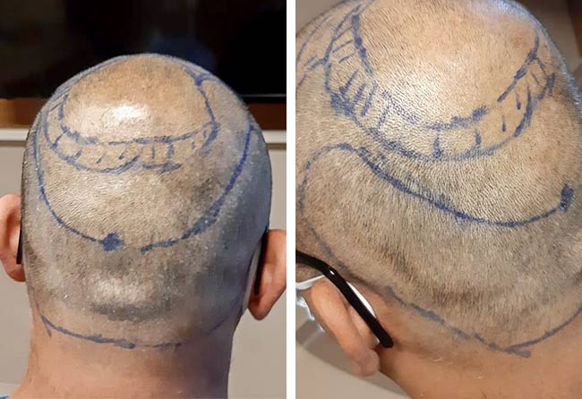 Patient Shahid Ahmad vor der OP mit der DHI Haartransplantation mit 4000 Grafts