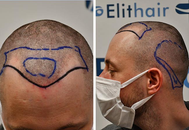 Cilian W vor der DHI Haartransplantation mit 3140 Grafts