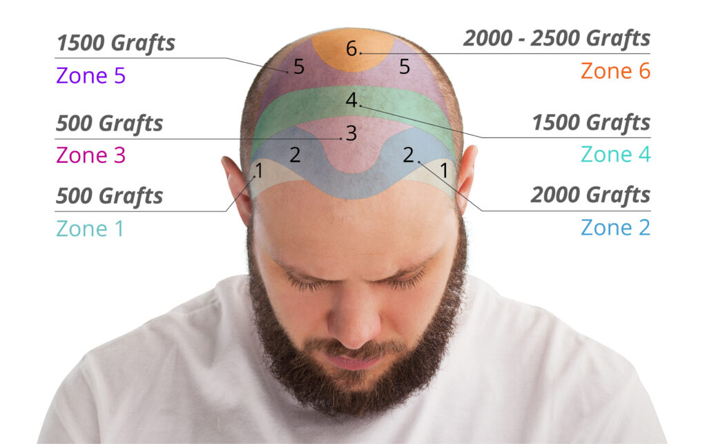 Grafik der Anzahl der Grafts, die zur Abdeckung verschiedener Bereiche bei einer Haartransplantation benötigt werden.