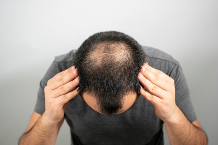 Kopf eines Mannes mit androgenetischer Alopezie von oben mit Blick auf Geheimratsecken und Tonsur