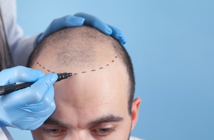 Bei einem Patienten wird vor der Haartransplantation die Haarlinie eingezeichnet