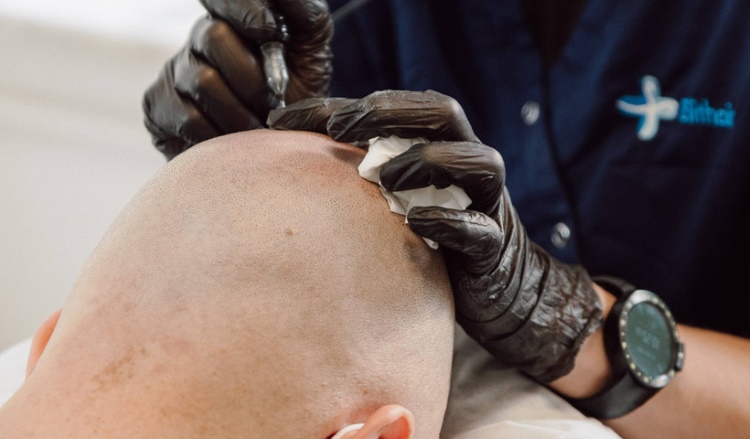 Patient mit Glatze bekommt eine Nano Haarpigmentierung