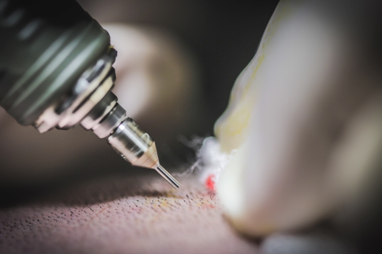 Eine FUE Haartransplantation ohne Vollnarkose wird mit einer Hohlnadel durchgeführt