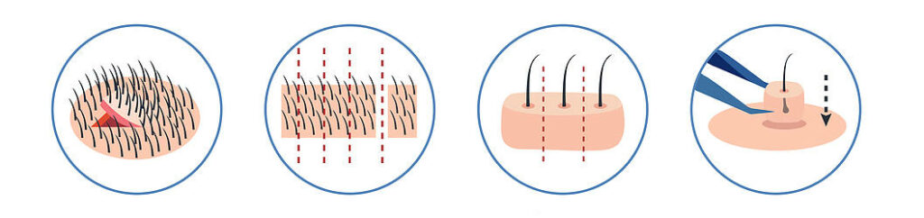 Schaubild in 4 Teilen zur Darstellung der FUT Haartransplantation