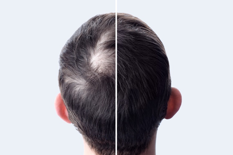 Hinterkopf eines Patienten im Vorher Nachher Vergleich bei der Haartransplantation Verdichtung
