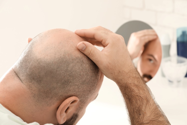 Mann mit Tonsur hat sich die Haare abrasiert und schaut in den Spiegel